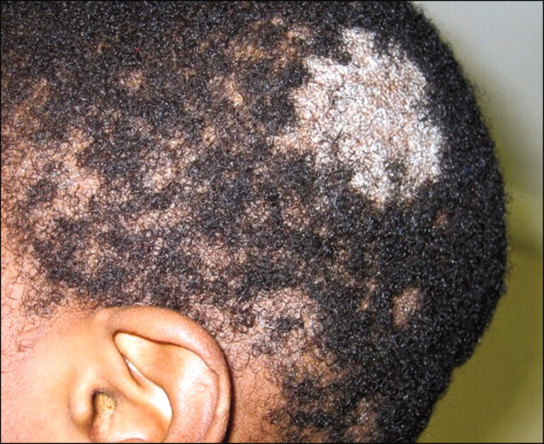 Tinea Capitis (Dikwaba)